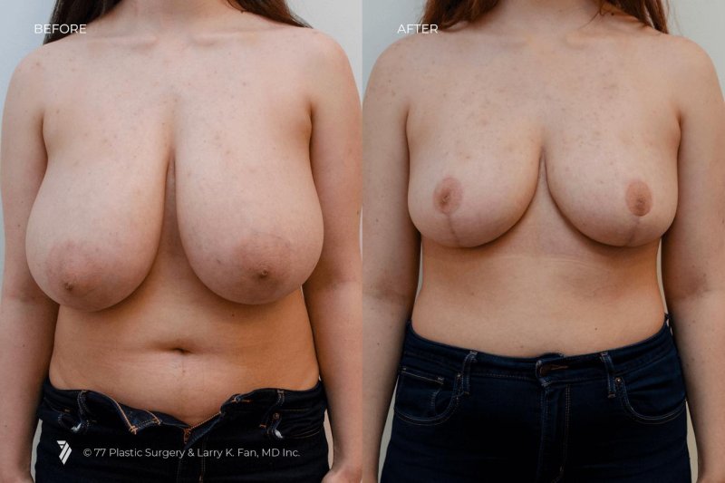 Breast, Breast plastic, Brows