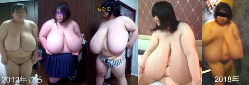 Gigantomastia in girls of adolescents XXX, Very big tits Norm Stitz, Huge boobs macromastia