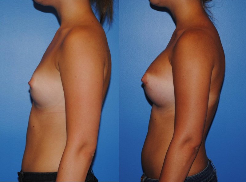 Breast plastic, Before and after breast augmentation, For breast augmentation