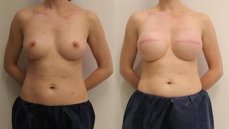 Breast plastic, Brows, Breast reduction
