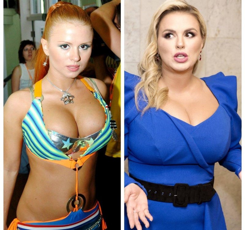 Anna Semenovich in youth breast, Anna Semenovich, Anna Semenovich before and after plastic