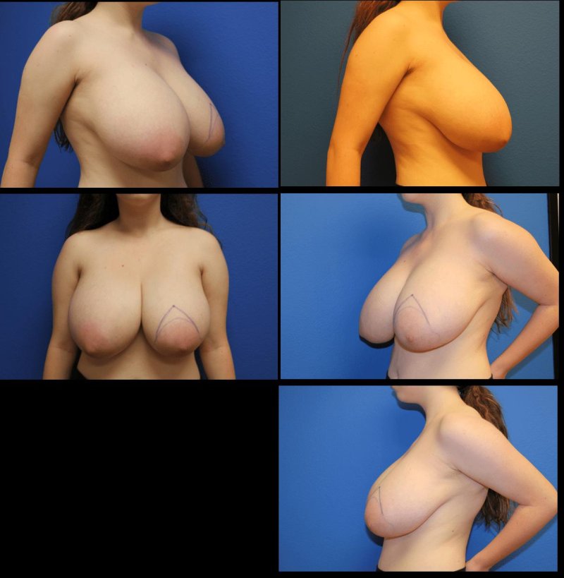 Breast reduction, Macomastia gigantomastia, For breast augmentation
