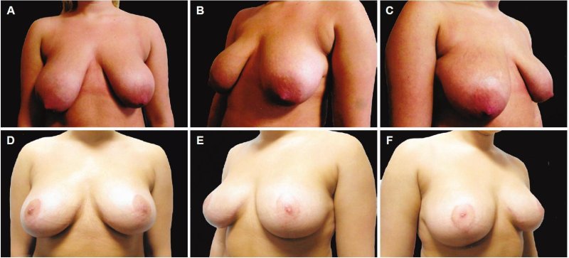 Breast hypertrophy, For breast augmentation, Breast plastic