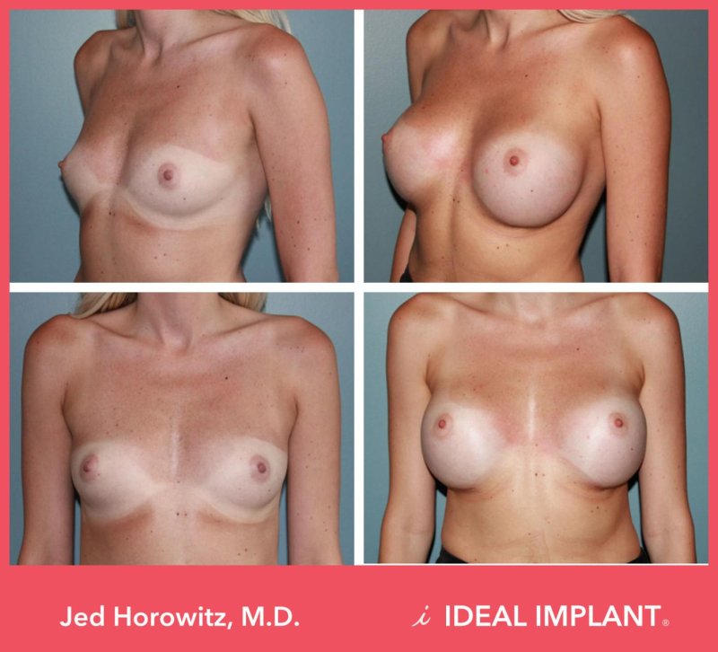 Huge boobs implants, Breast enlargement, Before and after breast augmentation