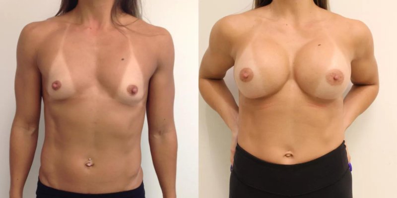 Breast plastic, Before and after breast augmentation, Breast enlargement