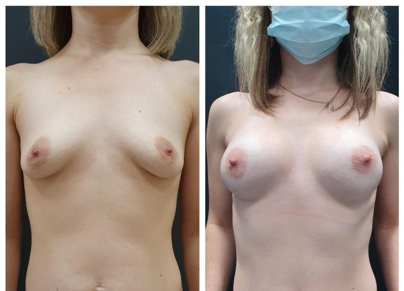 Breast plastic, Breast plastic surgery, Breast enlargement