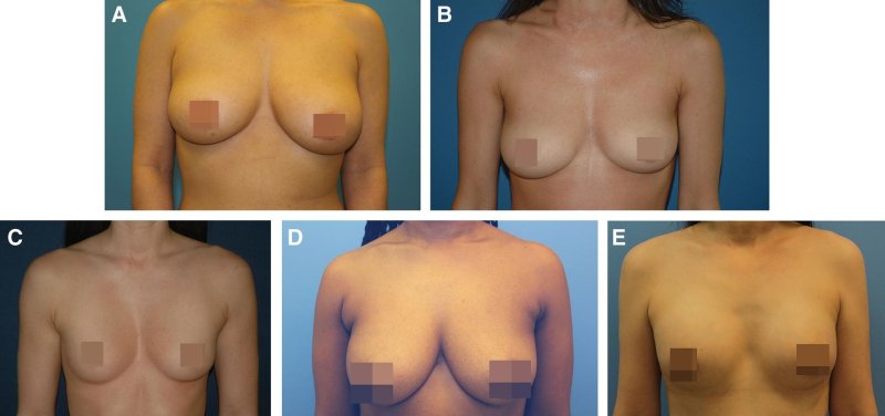 Breast plastic, Breast reduction dr richard, Breast augmentation