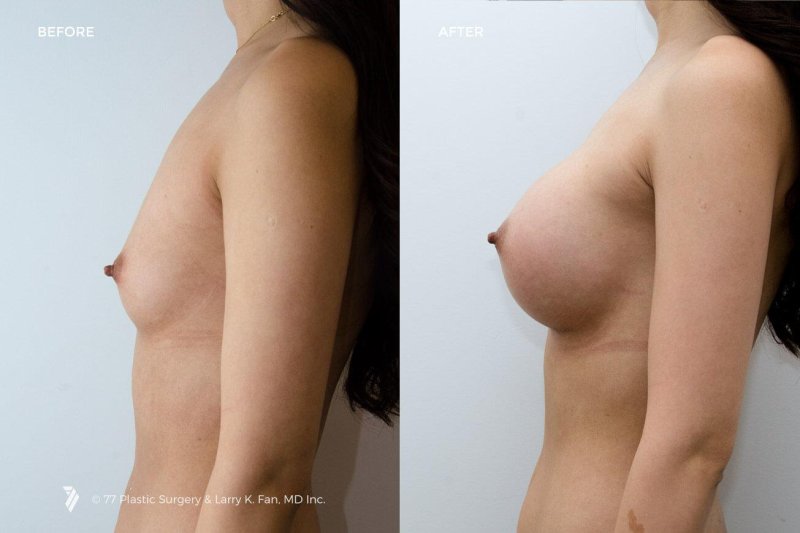 Breast enlargement, Before and after breast augmentation, Breast plastic