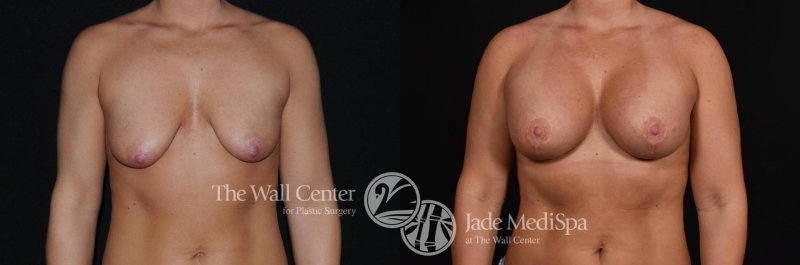 Breast augmentation, Breast reduction dr richard, Breast plastic