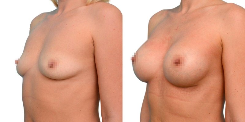 Standing female breast plastic, Breast plastic, Breast enlargement
