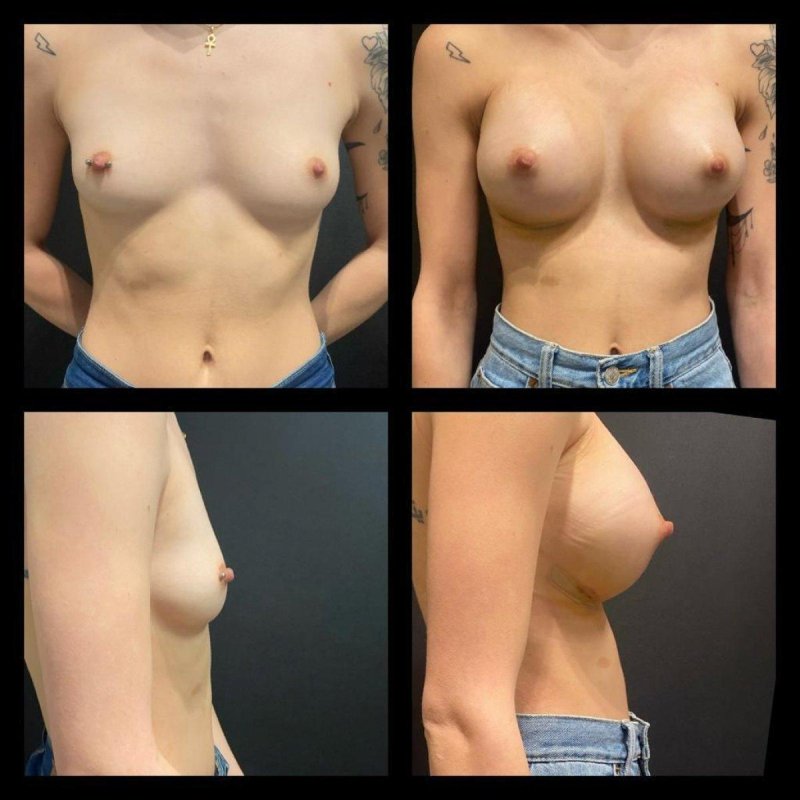 Breast plastic, Breast enlargement, Breast augmentation