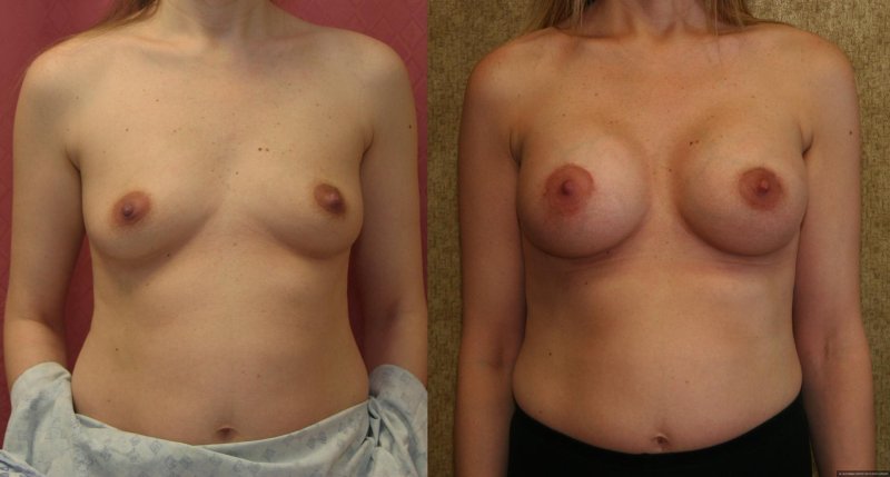Breast plastic, Breast augmentation, Breast enlargement