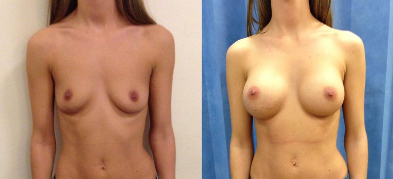Breast reduction dr richard, Naked boobs in different directions, Gynecomastia liposuction
