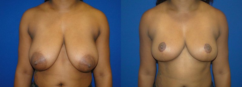 Macromastia breasts reduction before after, Breast reduction dr richard, Breast augmentation