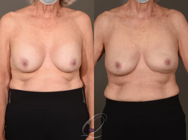 Breast implant, Breast augmentation, Breast enlargement