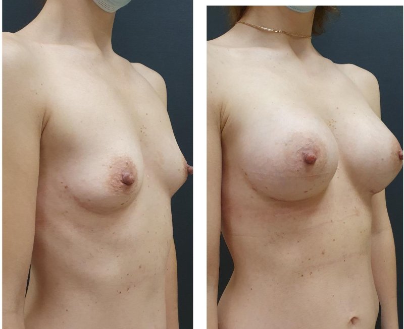 Breast plastic surgery, Breast plastic, Breast enlargement