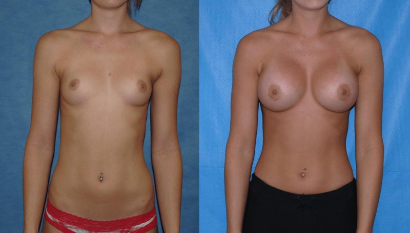 Male breast plastic, Breast enlargement, Breast augmentation