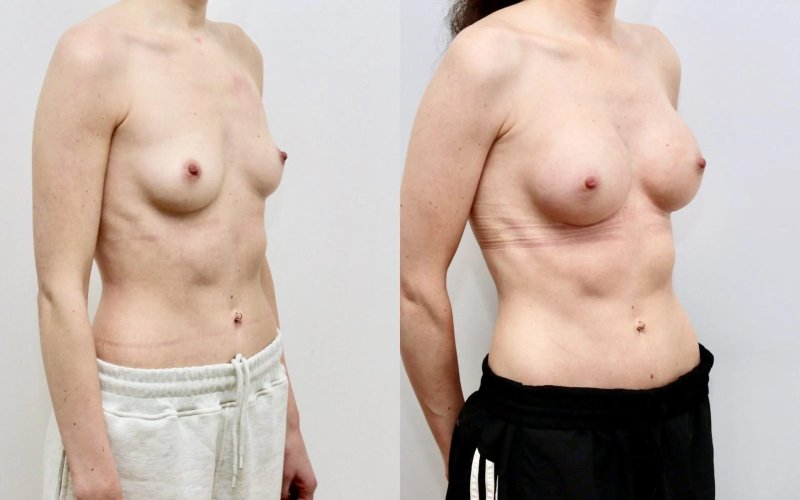 Breast plastic, Before and after breast augmentation, Breast augmentation