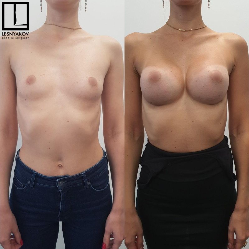 Breast plastic, Before and after breast augmentation, Breast enlargement