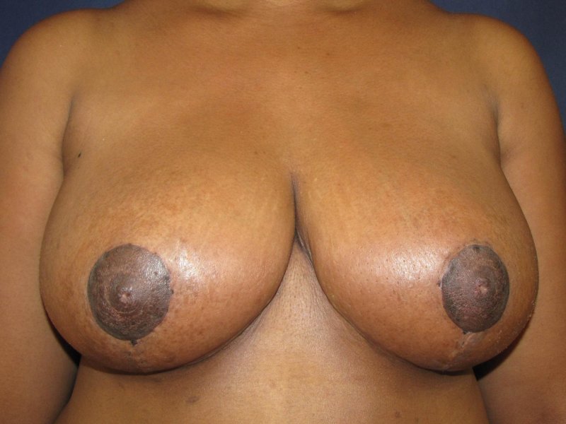 Breast reduction, Brows, Breast plastic