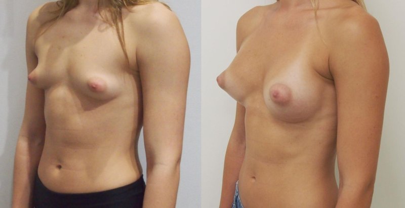 Breast enlargement by hormones in transsexuals, Before and after breast augmentation, Estradiol gynecomastia