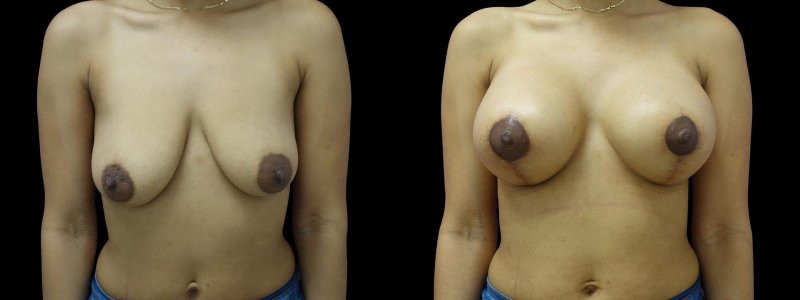 Breast implant, Breast lift, Breast plastic