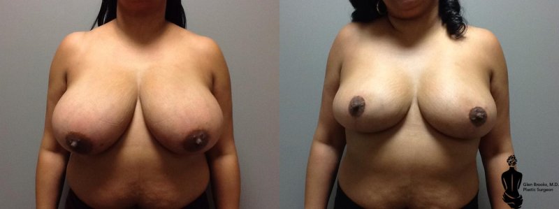 Gigantomastia Breast Reductions, Breast reduction, Breast surgery