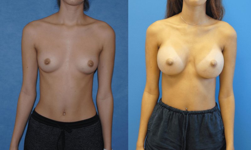 Porn actresses enlarging the throat, Increased breasts, Before and after breast augmentation