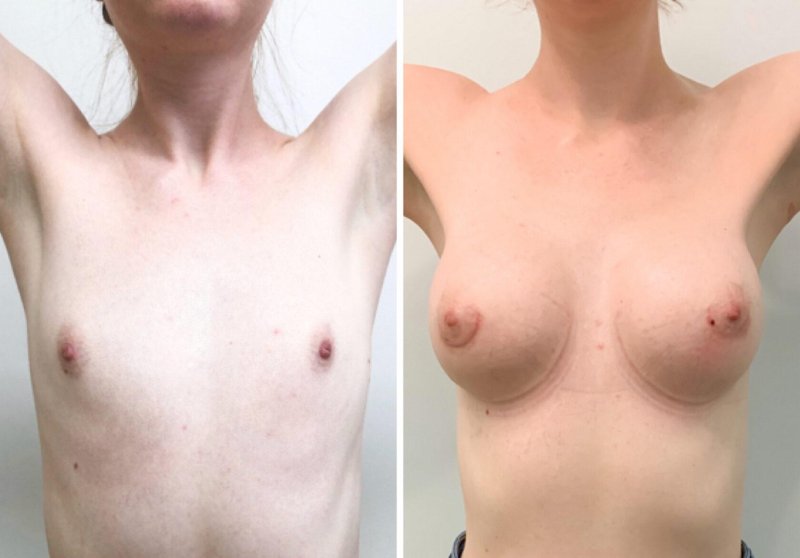 Breasts after implantation, Before and after breast augmentation, Breasts after enlarging by implants