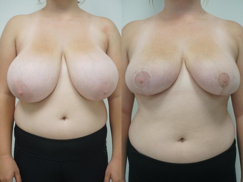Breast reduction, Breast, Breast plastic