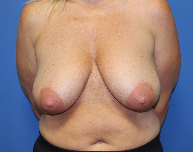 Breast reduction, For breast augmentation, Breast plastic