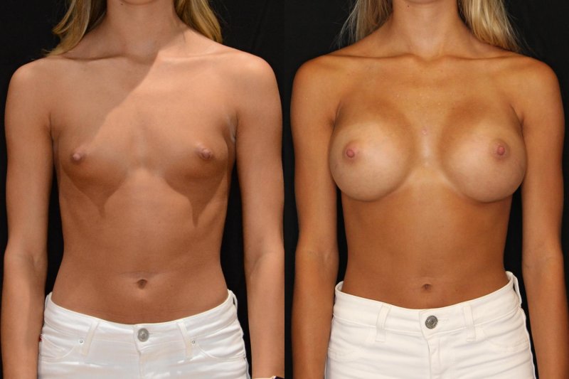Breast plastic, Breast augmentation, Breast enlargement