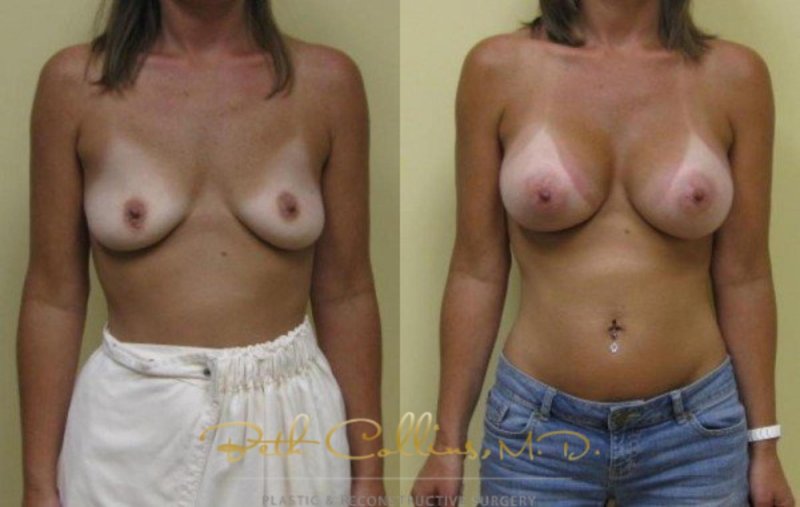 Breast enlargement porn, Nikki benz before and after breast enhancement, Breast reduction dr richard