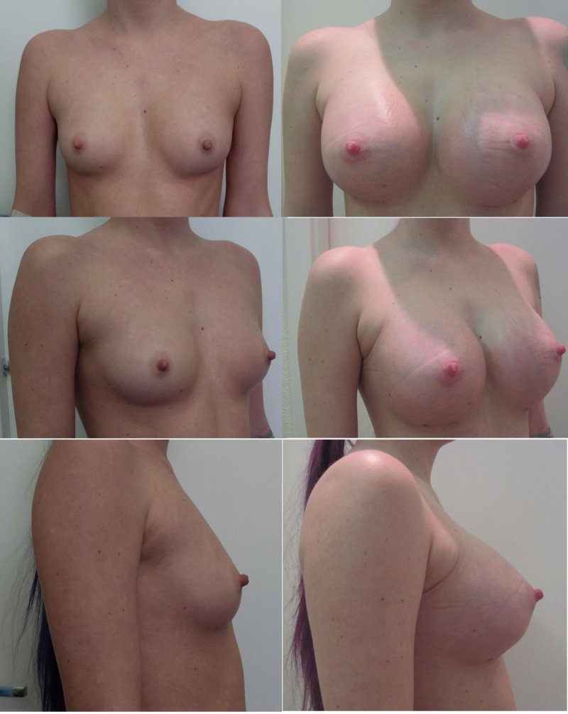 Before and after breast augmentation, Naked boobs before and after surgery, Breast enlargement
