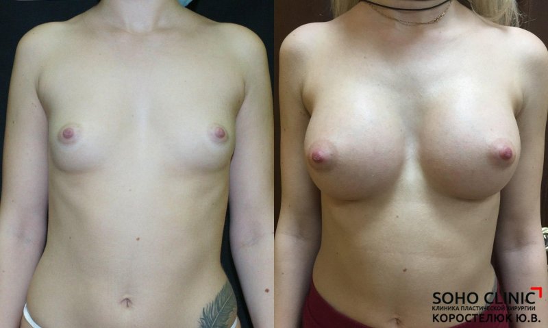 Before and after breast augmentation, Breast plastic before and after, Breast plastic