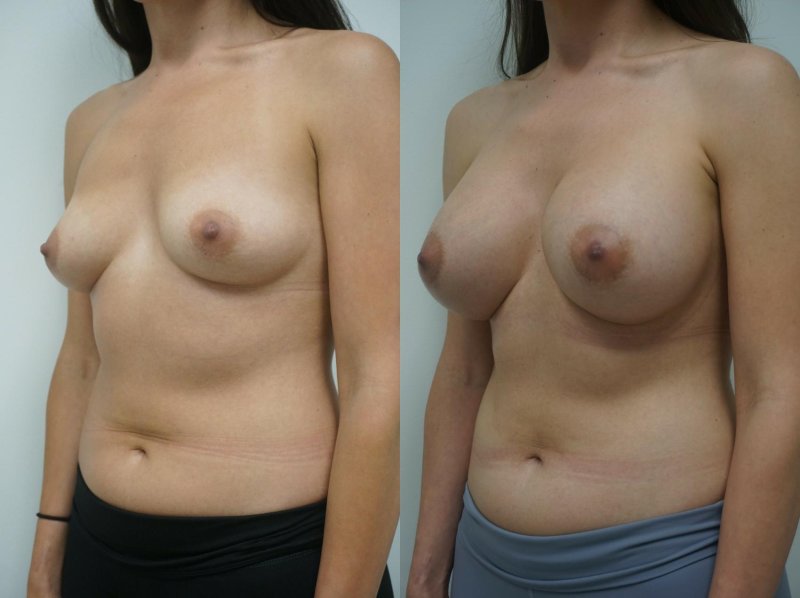 Breast plastic, Before and after breast augmentation, Breast enlargement
