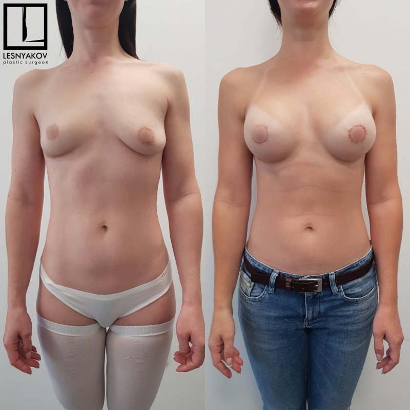 Asymmetric breasts, Asymmetry of breasts in women, Breast plastic