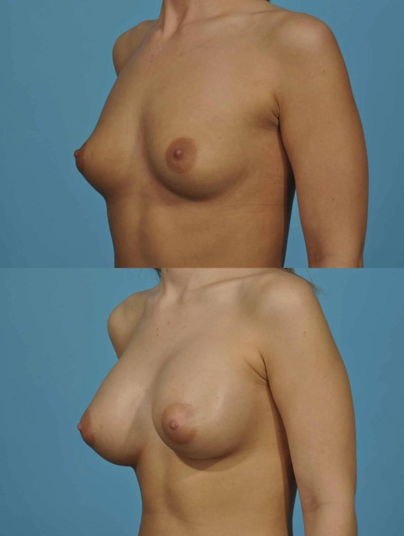 For breast augmentation, Breast plastic, False gynecomastia