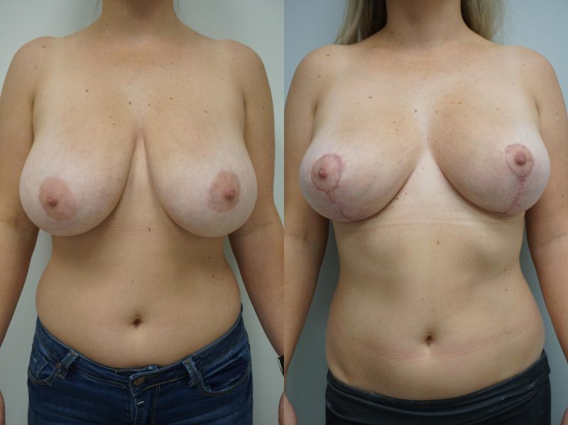 Mammoplasty gigantomastia, Breast reduction, Breast plastic