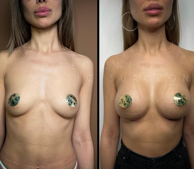 Breast plastic, Breast enlargement, Before and after breast augmentation