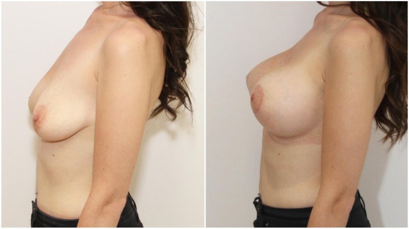 Breasts of giving birth to erotic girl, Breast enlargement, Breast plastic