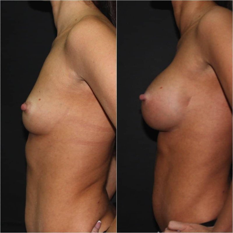 Feminizing mammoplasty, Breast plastic, Breast enlargement