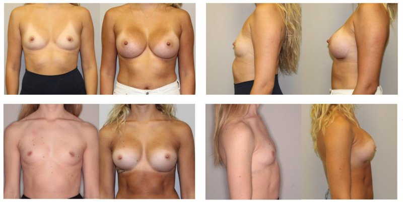 Breast augmentation, Breast reduction dr richard, Breast implant
