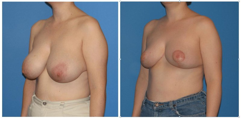 Breast reduction, Perfect boobs, False gynecomastia