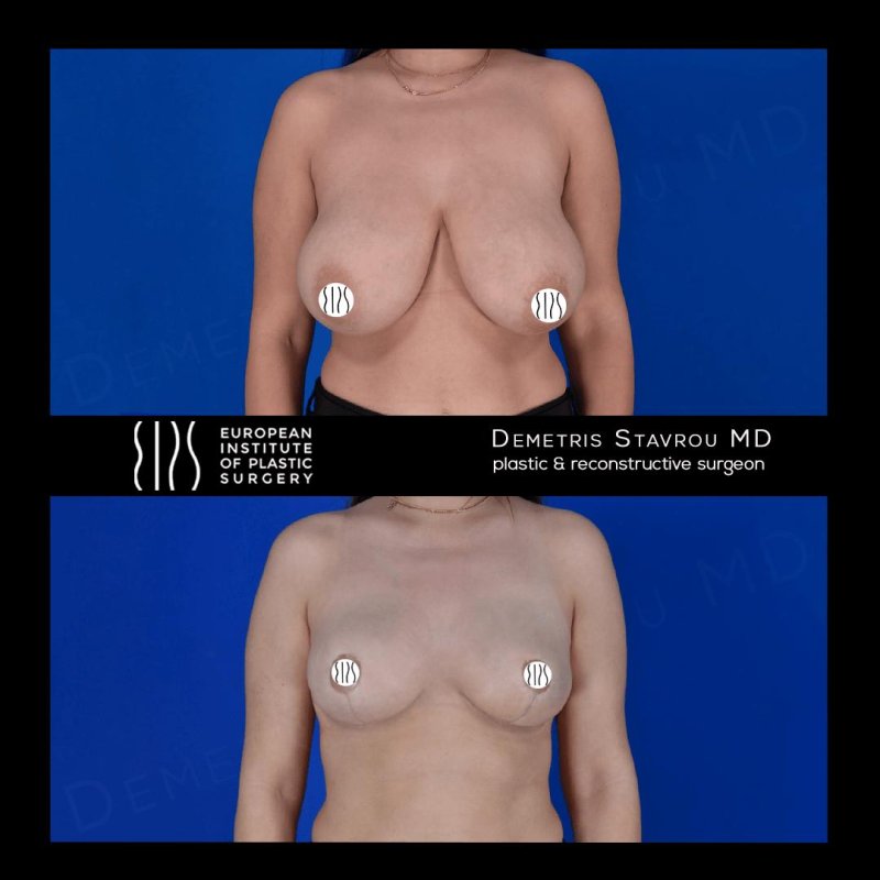 Breast reduction, Breast reduction dr richard, Breast plastic