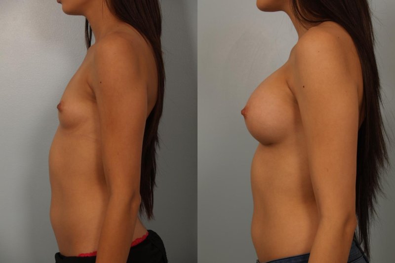 Before and after breast augmentation, For breast augmentation, Breast plastic