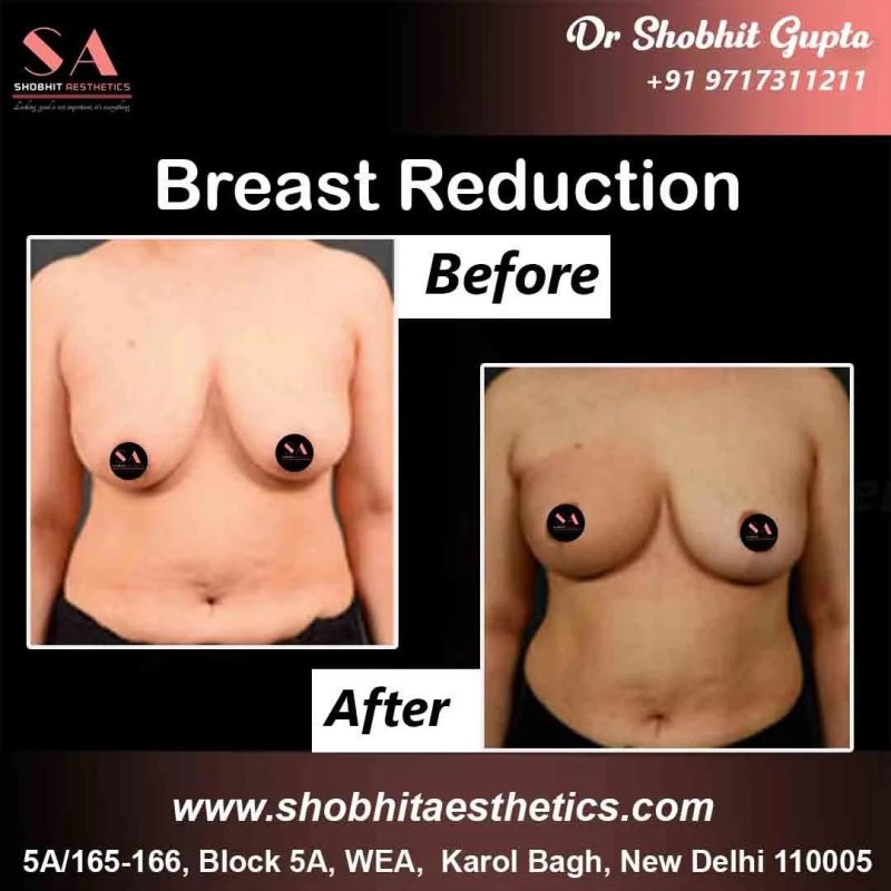 Breast reduction, Breast augmentation, Breast enlargement
