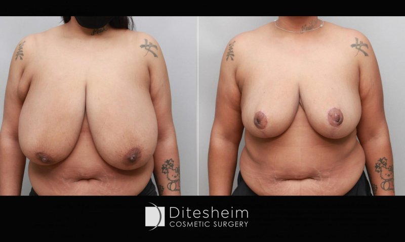 Board breast, Breasts in women, Ashimetry of breasts in women
