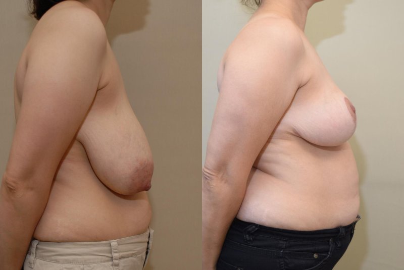 Breast, Breast reduction, Breast liposuction