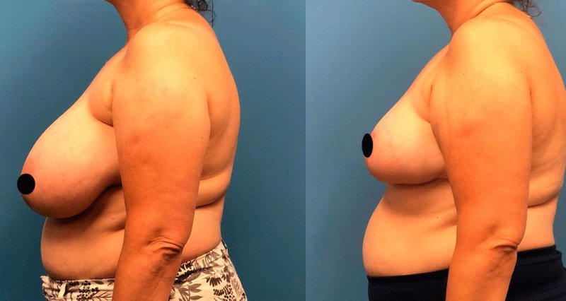 Breast reduction, For breast augmentation, Breast reduction operations